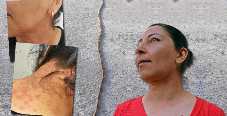 Evinin bahçesini temizledi, hastanelik oldu! Yüzü, boynu, gözleri ve kolları kızarıp kabardı