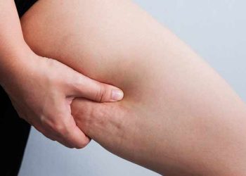 Selülite karşı yepyeni bir tedavi yöntemi: “EnzimatikHA”